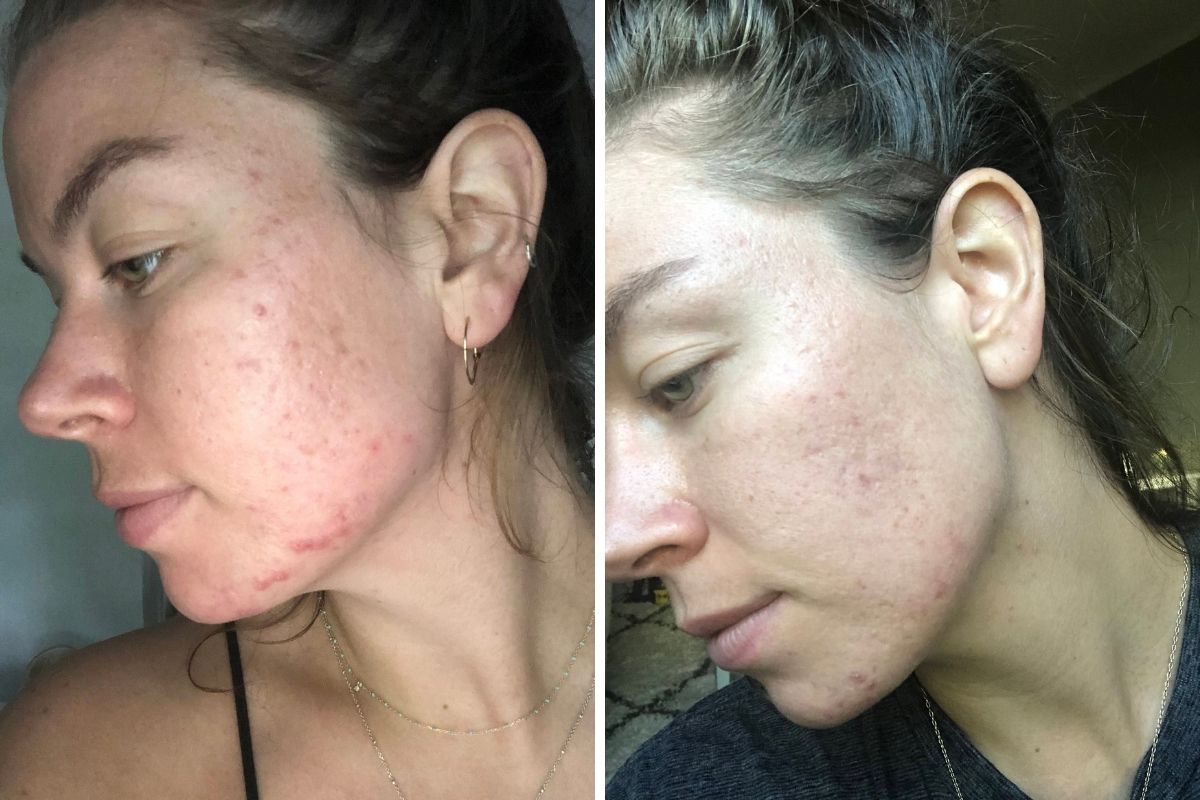 How Eating Plant-Based Meals Helped My PCOS-Related Acne and Weight Gain